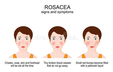 Rosacea. Signs and Symptoms of Skin Cosmetic Problems Stock Vector ...