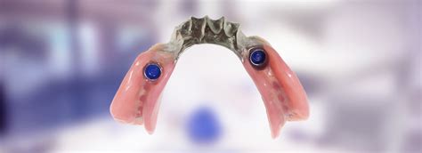 Implant Supported Partial Dentures