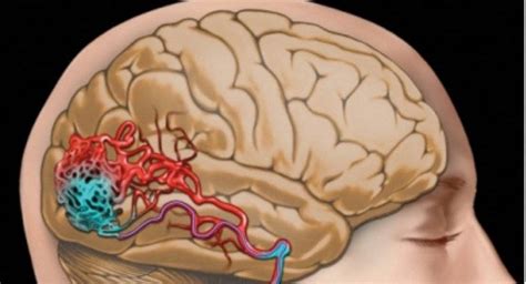 Conoce Sobre Las Malformaciones Arteriovenosas Top Doctors