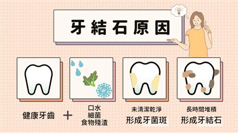 為什麼要牙結石清除有辦法自行清除牙結石嗎預防牙結石的3種處理方法