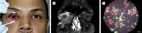 Magnetic Resonance Imaging In Epidemic Adenoviral Keratoconjunctivitis Cornea Jama