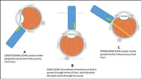 Ultrasound B-Scan: A Ready Reckoner for the Postgraduates