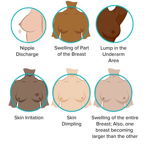 how to know if u got breast cancer