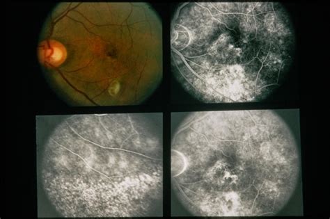 Central Serous Retinopathy - Retina Image Bank