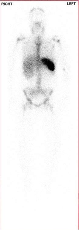 Indium Scan Showing Intense Uptake In The Spleen And Uptake In