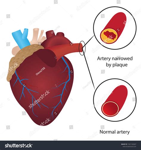 Real Unhealthy Human Heart