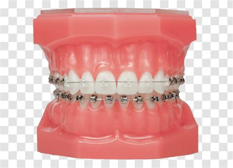 Damon System Dental Braces Clear Aligners Orthodontics Self Ligating