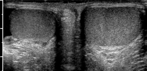 Testicular Size Asymmetry Transverse Sonogram Of Both Testes In A Download Scientific Diagram