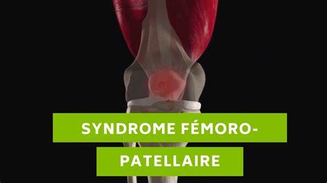 Le Syndrome F Moro Patellaire C Est Quoi Nxt Generation Physio