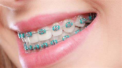 Metal braces – Im Orthodontics