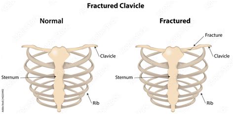 Fractured Clavicle Labeled Diagram Stock Vector | Adobe Stock