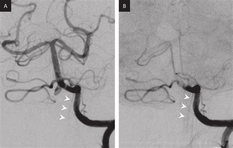 Anteroposterior Views Of The Left Vertebral Angiogram A Arterial