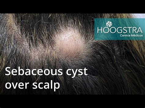 Sebaceous Cyst Scalp