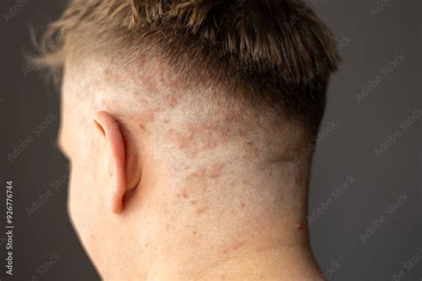 Psoriasis On The Skin Close Up Scalp Photos Of Dermatitis And Eczema