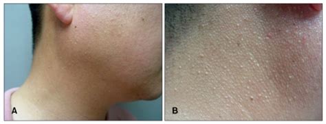 multiple firm skin colored  mm sized papular lesions