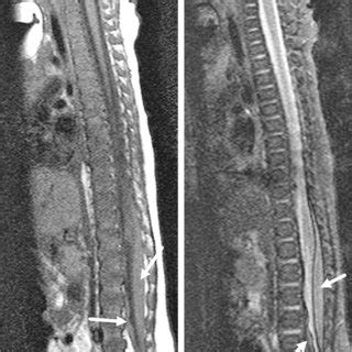 Abusive Head Trauma In A Month Old Boy A Sagittal T W Mri Of The