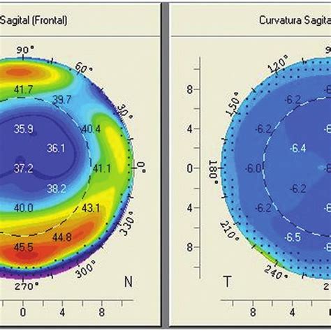 Corneal Topography In A Keratoconus Eye Download Scientific Diagram