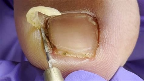 There Are So Many Impurities Hidden Under The Huge Ingrown Toenail