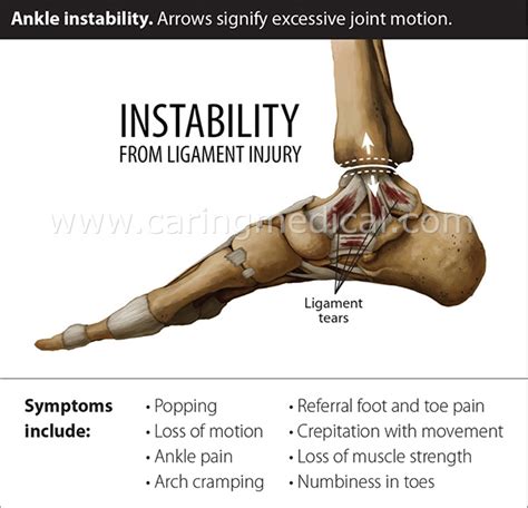 Ankle Impingement Non Surgical Treatment