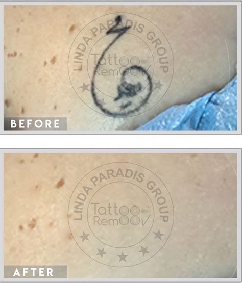 Non Invasive Tattoo Removal Technique The Tattoo Remoov 88