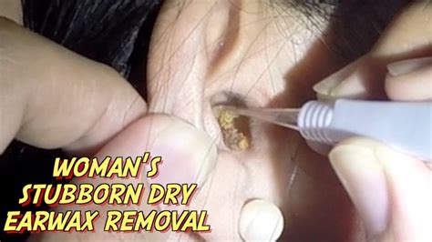 Woman S Stubborn Dry Earwax Removal YouTube