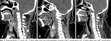 Figure 2 From A Case Of Retropharyngeal Abscess Treated By Vacuum Assisted Closure Application