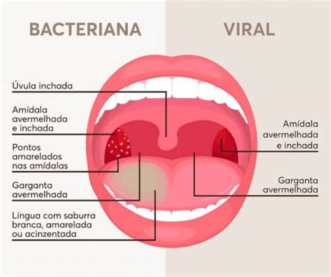 Amigdalite O Que Causas Tipos E Sintomas