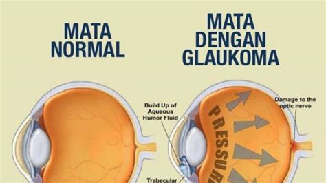 Mengenal Glaukoma Kelainan Pada Mata Yang Perlu Diwaspadai