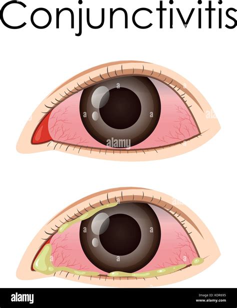 Diagrama Que Muestra La Conjuntivitis En La Ilustración Imagen Vector