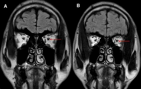 The MRI map during hospitalization. The dilatation of the optic nerve ...