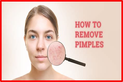 How To Remove Pimples On Face - Digital Marketer - Medium