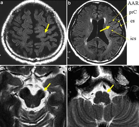 Imaging Of Corticobasal Degeneration Syndrome Semantic Scholar