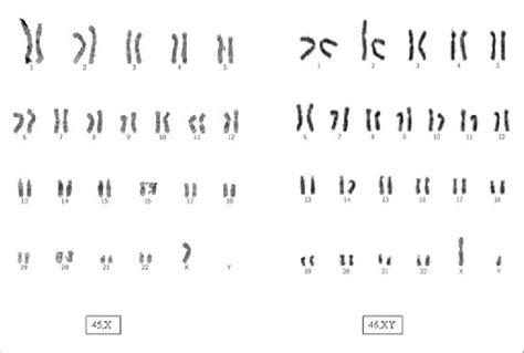 Gtg Banded Karyotypes Of The Case Showing 45x75 46xy25