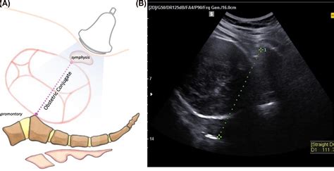 Ultrasound In Labor Clinical Practice Guideline And Recommendation By