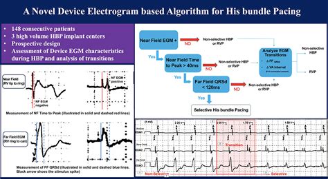 Biventricular Pacemaker Ecg