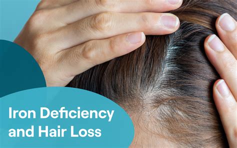 Iron Deficiency and Hair Loss: What to Know – Sanguina