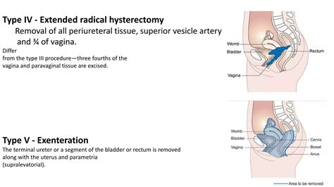 Surgical Management Of Carcinoma Cervix PPT