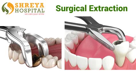 Dental extraction surgery is performed to remove difficult