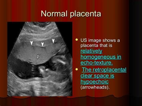 Placenta ultrasound