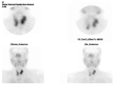 Sestamibi scan showing parathyroid hyperplasia. | Download Scientific Diagram