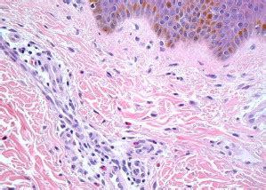 Systemic Mastocytosis | Oncohema Key