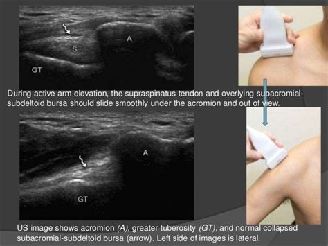 Shoulder Ultrasound