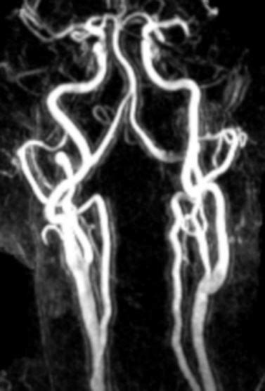 Carotids Mra Quick Reference Guide For Patients