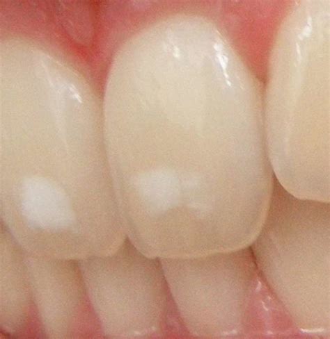 White Spots On Teeth Tips On How To Get Rid Of Them