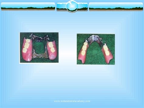 Selection Of Denture Base And Teeth For Rpd Certified Fixed Orthodon