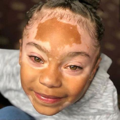 Vitiligo In Babies Pictures Takako Foy