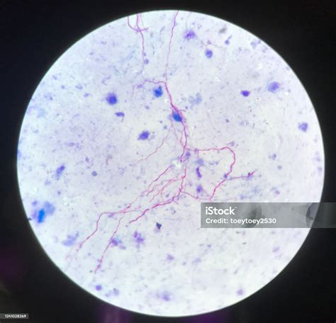 Red Branching Mycobacterium Tuberculosis On Blue Background In Modified Acid Fast Bacilli