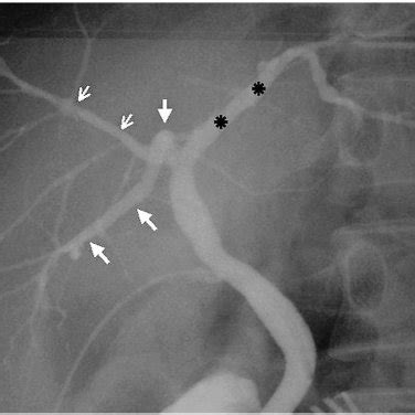 Triple Confluence Type Operative Cholangiogram Demonstrates