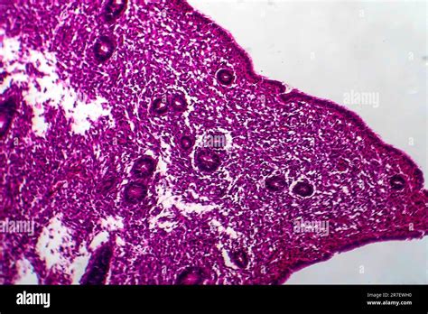 Endometrial Hyperplasia Light Micrograph Of A Section Through Tissue