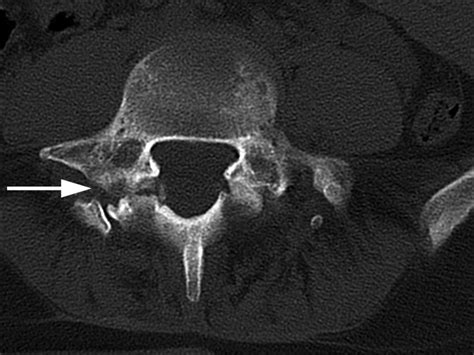 Radiographic And Functional Outcome Of Posterolateral Lumbosacral